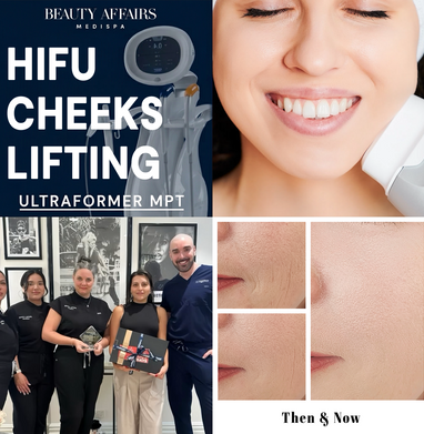 HIFU Cheek Lift Ultraformer Treatment - Brookvale