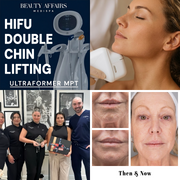 HIFU Double Chin Ultraformer MPT Treatment - Brookvale