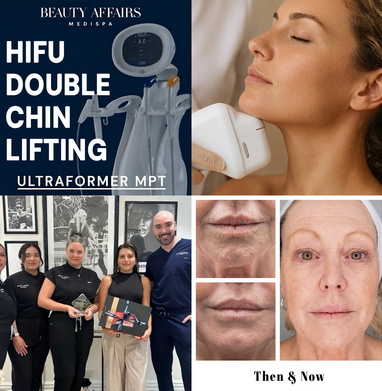 HIFU Double Chin Ultraformer MPT Treatment - Sydney CBD