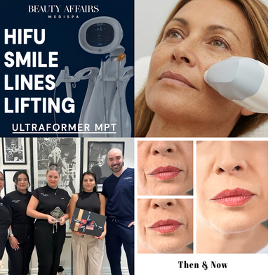 HIFU Smile Line Lifting Ultraformer Treatment - Brookvale