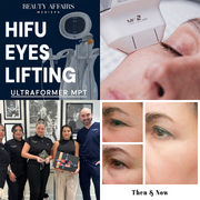 Bespoke Luxury HIFU Eye Lifting Ultraformer Treatment - Sydney CBD