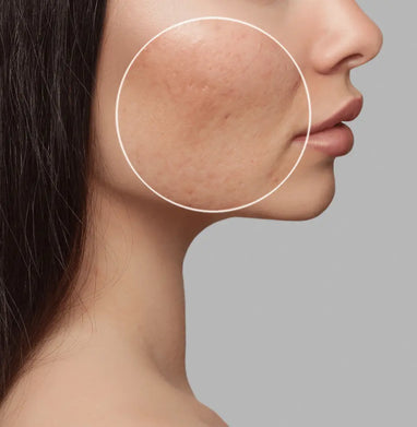 Bespoke Luxury Acne & Scar Removal - Brookvale Beauty Affairs MediSpa