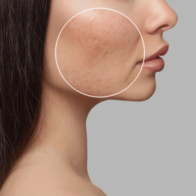 Bespoke Luxury Acne & Scar Removal - Sydney CBD