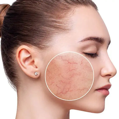 Bespoke Luxury Rosacea Treatment - Brookvale